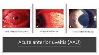 uveitis fogyás