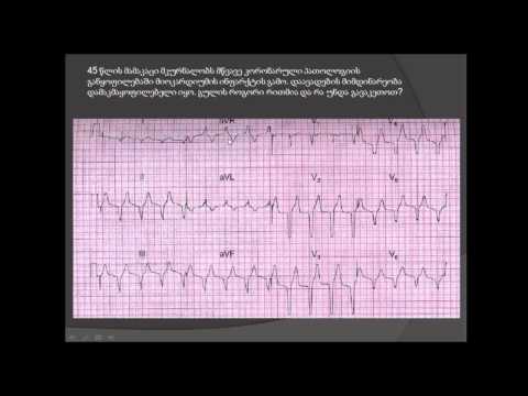 ეკგ ანალიზი / აჩქარებული იდიოვენტრიკულური რითმი (ნელი პარკუჭოვანი ტაქიკარდია) / ექტოპიური რითმი