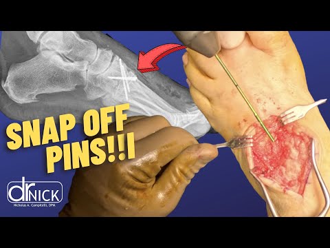 Mid Foot Fusion Surgery with Arthrex Snap Off Compression Pins | Dr. Nick Campitelli