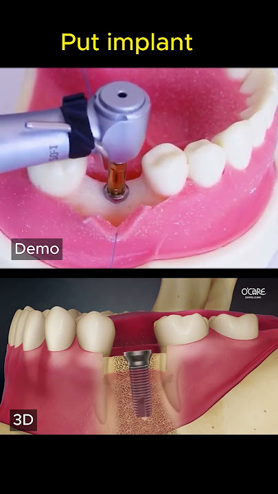 How is dental implant?
