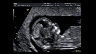 Nuchal Translucency Scan (11 Weeks - 14 Weeks) Nuchal Translucency Scan (11 Weeks - 14 Weeks)