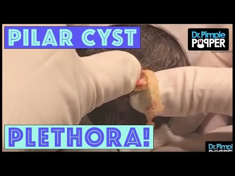 Pilar Cyst Plethora & Popaholics Unite!