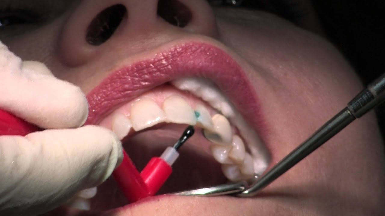 Composite Fillings YouTube