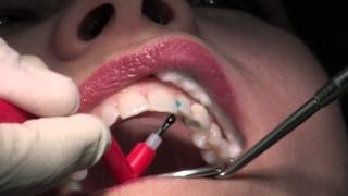 Composite Fillings