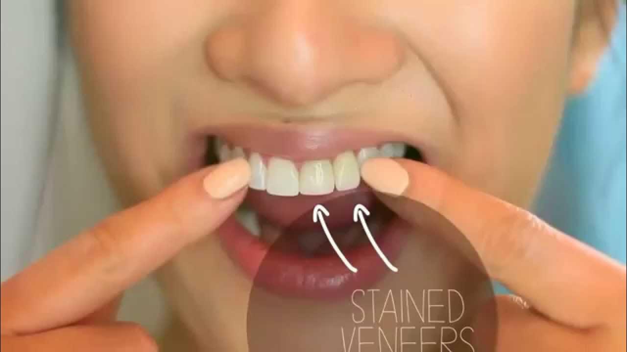 Braces and Teeth Whitening Johannesburg Sandton and Bryanston