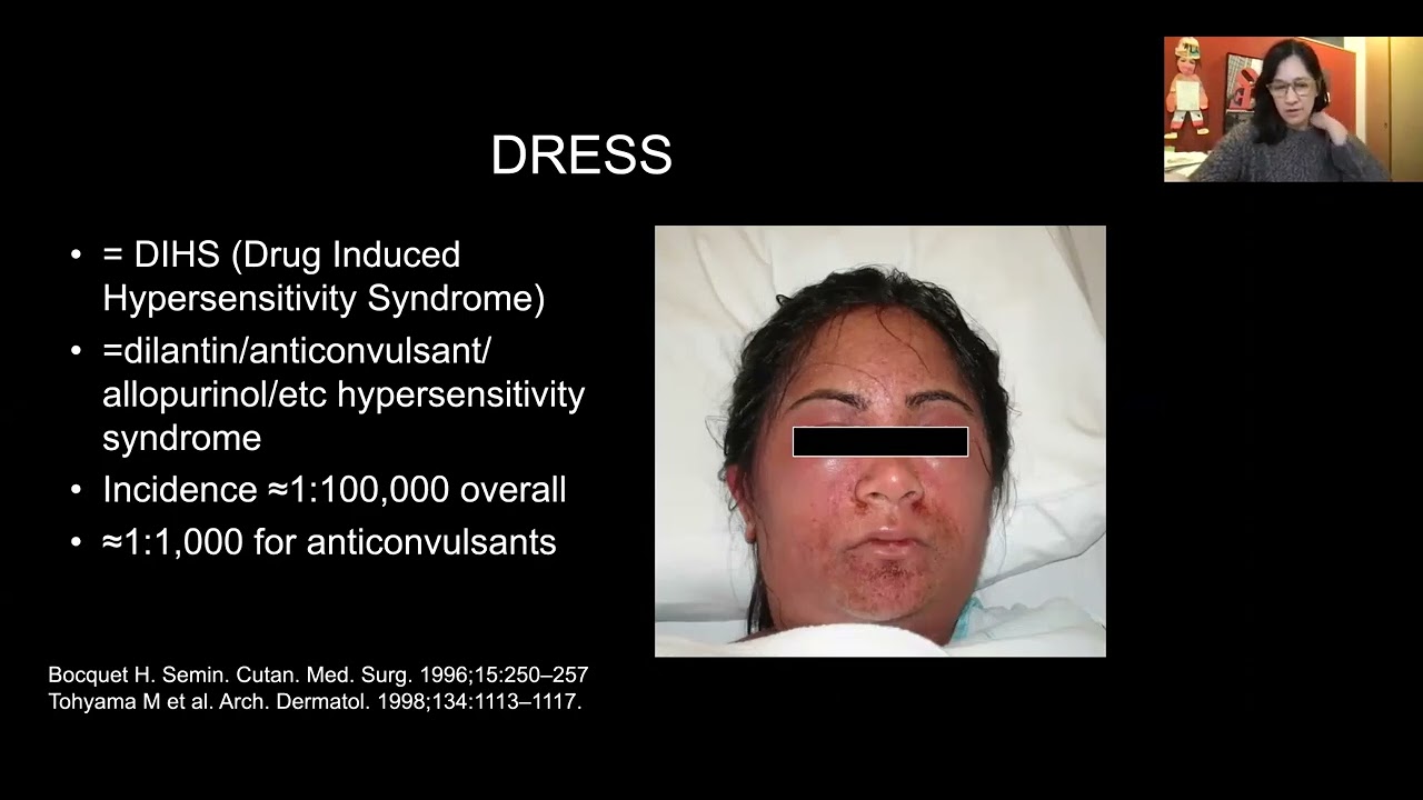 Drug Reactions With Eosinophilia And Systemic Symptoms DRESS A Drug Reactions With Eosinophilia And Systemic Symptoms DRESS A