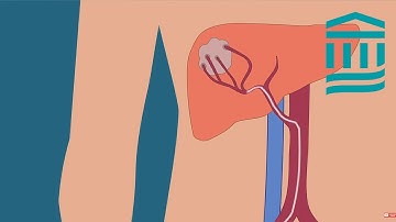 What is a TACE Procedure?