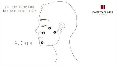 Profhilo BAP face technique at Dameto Clinics International