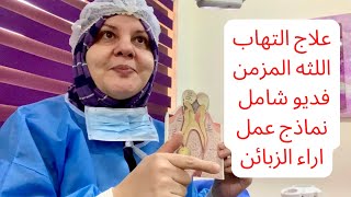 علاج اللثه التهاب اللثه فديو شامل يشمل علاج اللثه المنزلي والعيادي دكتور اسنان في اربيل علاج اللثه