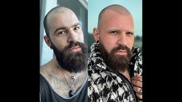 3rd Session Scalp Micropigmentation Complete Results @NOBOLD www.nobold.com #ScalpMicropigmentation