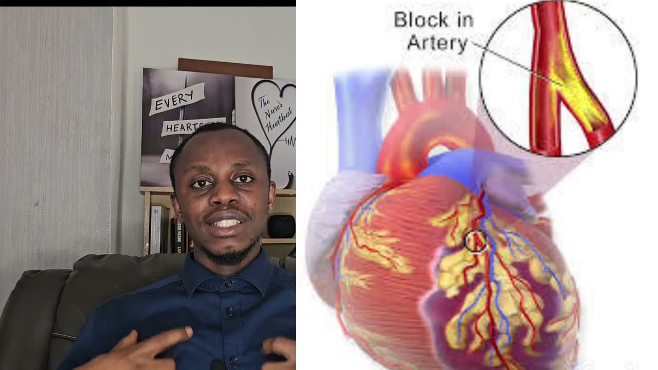 Myocardial Infarction (Heart Attack) – NCLEX Review