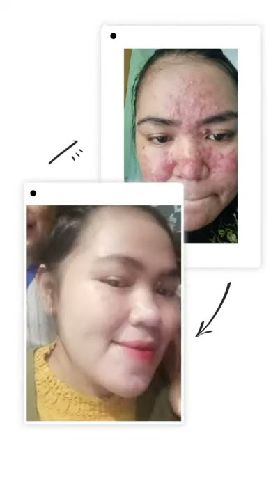 Review jglow acne