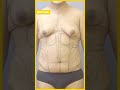 Transgender 360° Transformation Care Before &amp; After Results #liposuction #hourglass #shorts