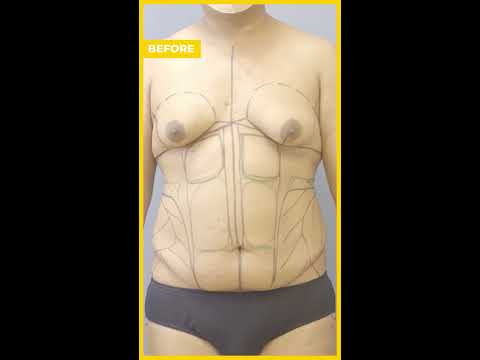 Transgender 360 Transformation Care Before After Results Liposuction Hourglass Shorts