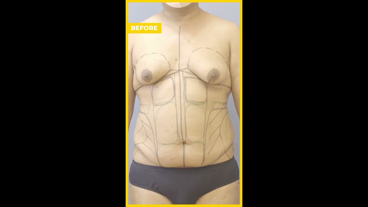 Transgender 360 Transformation Care Before After Results Liposuction Hourglass Shorts