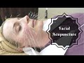 Facial Acupuncture | Korean Beauty Secret