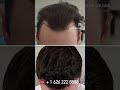 12 months update fue hair transplant result at almost full growth.  #fue #hair #fuehairrestoration