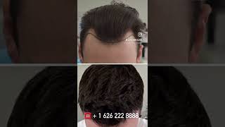 12 months update fue hair transplant result at almost full growth.  #fue #hair #fuehairrestoration