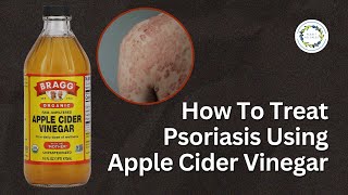 How To Treat Psoriasis Using Apple Cider Vinegar