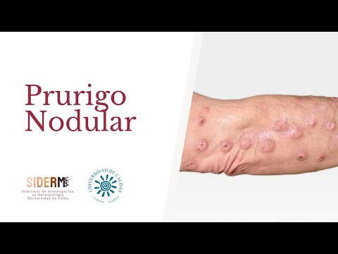 Vídeo: Signos Y Tratamiento Del Prurigo Nodular