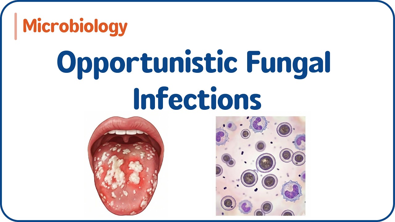8. Объяснение оппортунистических грибковых инфекций | Пациенты с ослабленным иммунитетом | USMLE ...