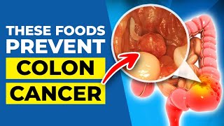 7 INCREDIBLE Foods to Prevent Colon CANCER.. by Heart Disease Code 3,974 views 5 months ago 15 minutes