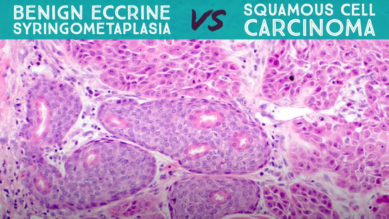 Eccrine Syringometaplasia - benign reactive mimic of squamous cell carcinoma (dermpath pathology)