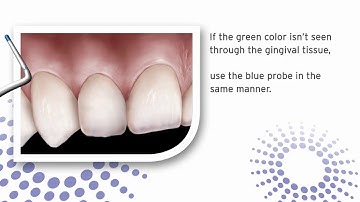 Hu-Friedy Biotype Probe Instructional Video