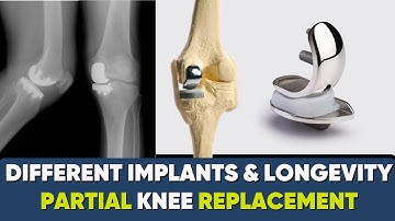 Life of (UKR)/ Partial knee replacement & types of implants of UKR