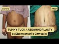 Should you consider tummy tuck? Watch to find out!