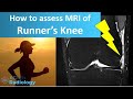 How Runner&#39;s Knee looks on MRI