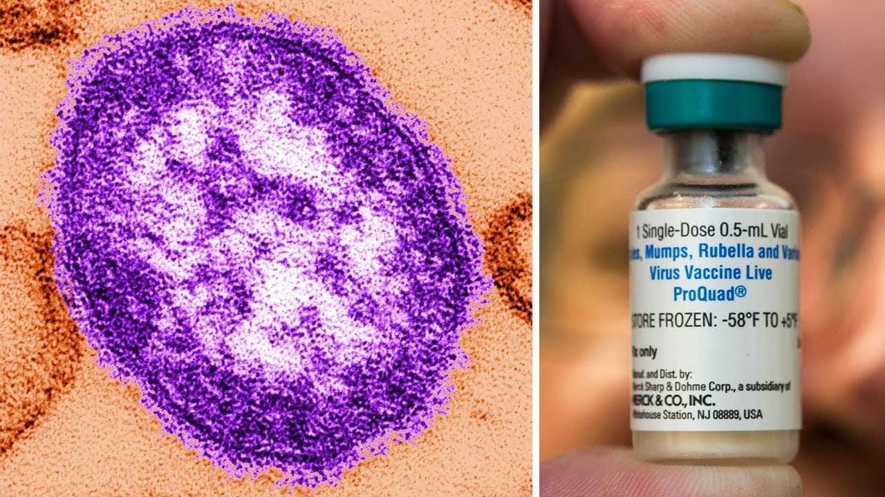 newspaper mockup What is measles? What to know about symptoms, vaccine & treatment