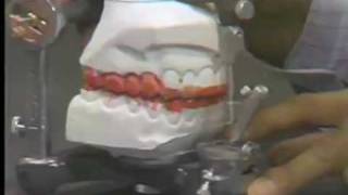 Occlusal Adjustment - Centric Relation