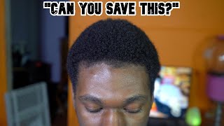 Major Hairline Reconstruction Watch Me Fix It