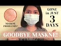 How to get rid of MASKNE in just 3 DAYS!!