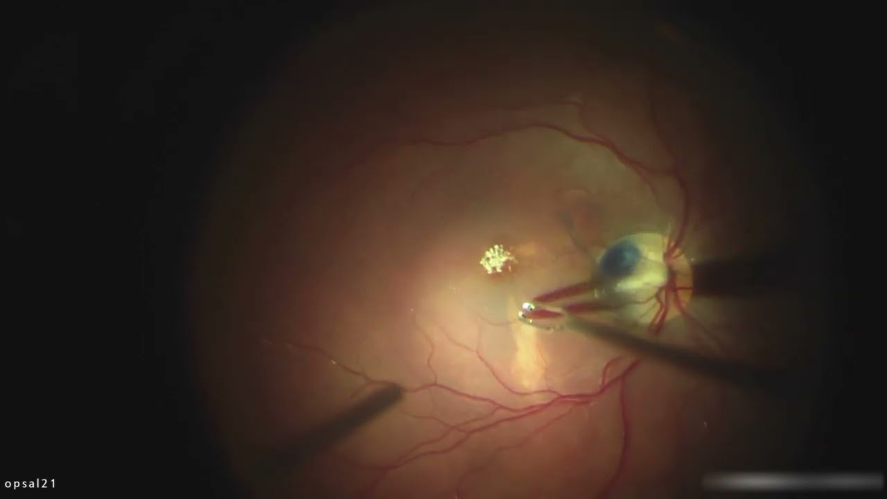 Vitrectomy of Optic Pit maculopathy with inverted ILM flap: 1 year outcome