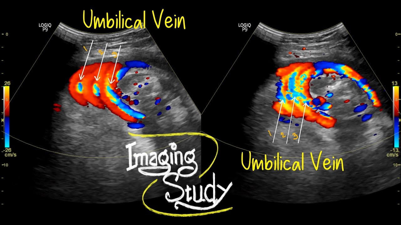 Three Layers Of Umbilical Cord Around The Fetal Neck Ultrasound three-layers-of-umbilical-cord-around-the-fetal-neck-ultrasound