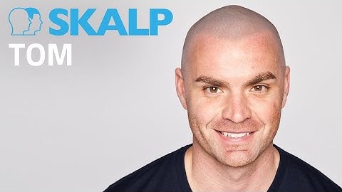 Scalp Micropigmentation Testimonial by Skalp® Tom