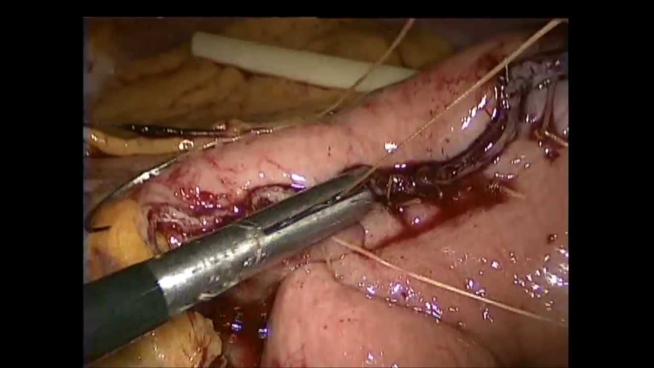 Northwestern Surgical Associates - Laparoscopic Distal Gastrectomy camera iphone 8 plus apk