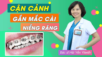 Cận cảnh quá trình gắn mắc cài niềng răng ||  Bác sĩ Yến Yteeth