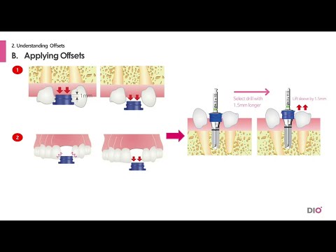 Understanding Sleeves and Offset