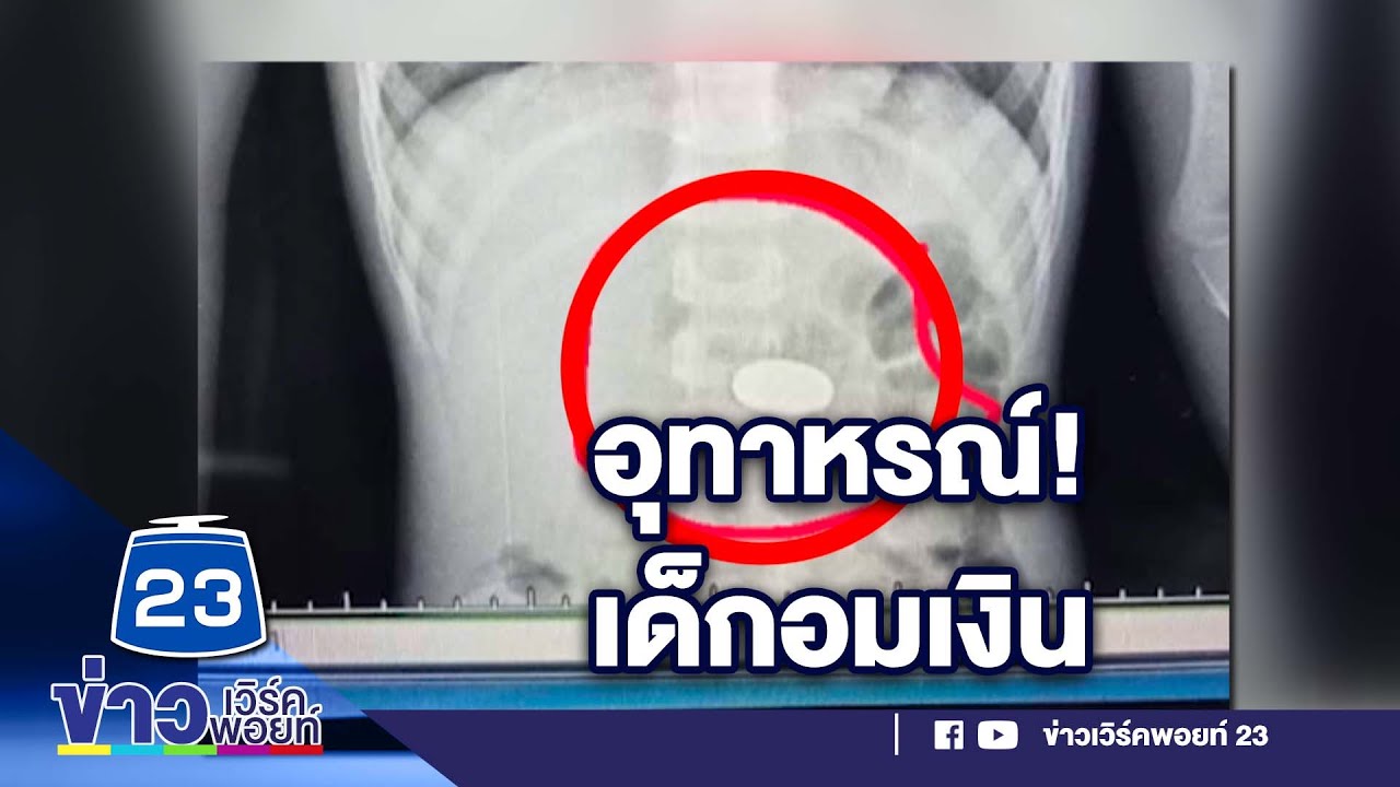 อุทาหรณ์ 5 ขวบอมเหรียญบาทหลุดลงคอ l ตลาดข่าว - ข่าวเช้าเวิร์คพอยท์ l 28 ก.พ.66