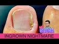 EXTRACTION OF INGROWN TOENAIL ** SIT BACK & ENJOY!