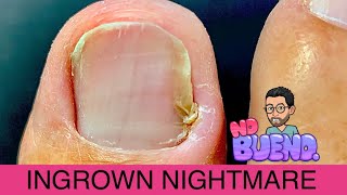 EXTRACTION OF INGROWN TOENAIL ** SIT BACK & ENJOY!