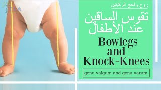 تقوس الساقين عند الأطفال - روح وفحج الركبتين   Bowlegs and Knock-Knees (subtitled)