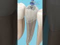 What happens inside a root canal? 🦷 The Dentist Clinic 😷