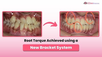 Root Torque Simplified: Managing Crowding with the Innovative BaTR Bracket System | Ezeebraces