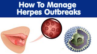 How To Manage Herpes Outbreaks? Natural Home Remedies For Herpes And Its Outbreaks