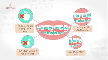 Khắc phục hàm răng khấp khểnh lệch lạc