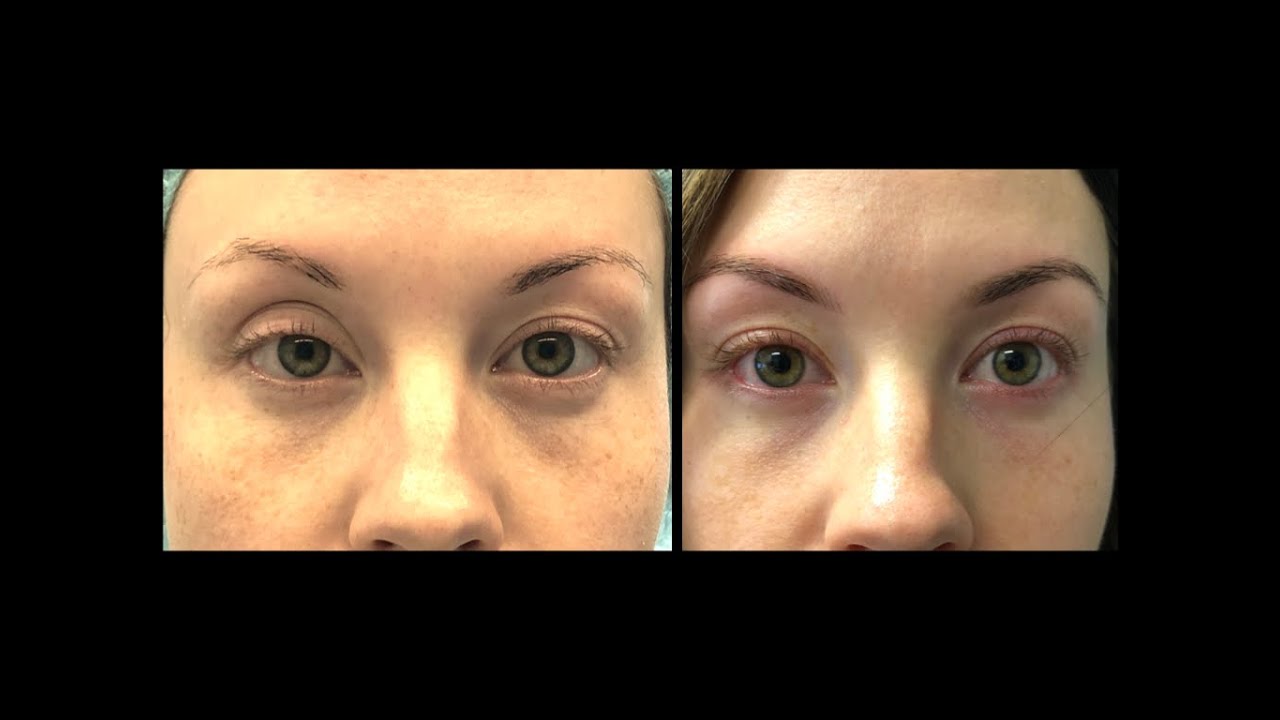 Cure de ptose par approche postérieure sans suture Sutureless